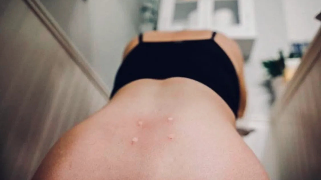 My experience with Sterile Water Injections