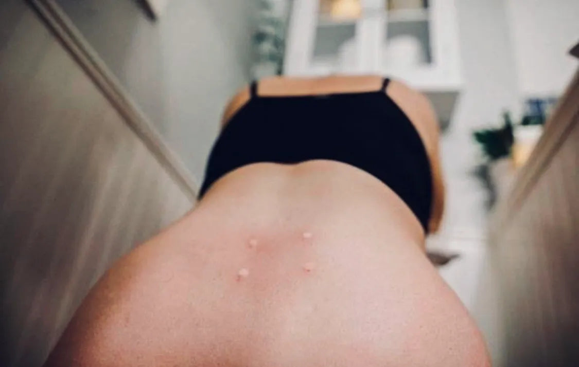 My experience with Sterile Water Injections